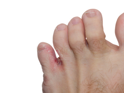 eczema on toes #10