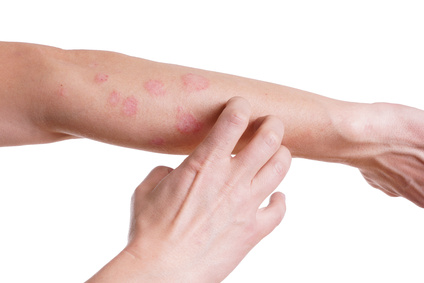 Hautausschlag am Arm